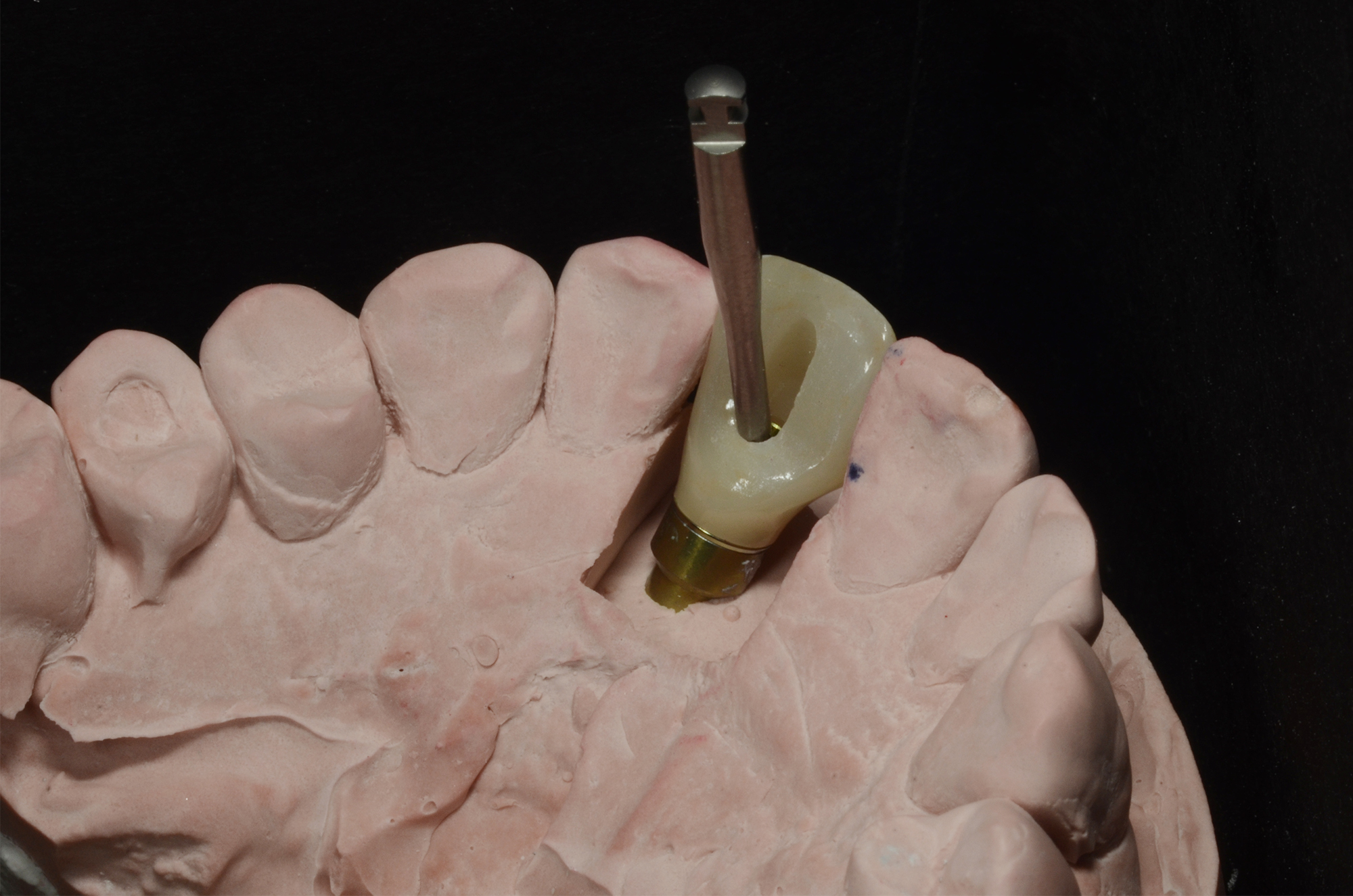 Zirconia Implant Crown on Angulated Abutment